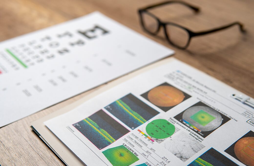How Dry AMD Is Diagnosed