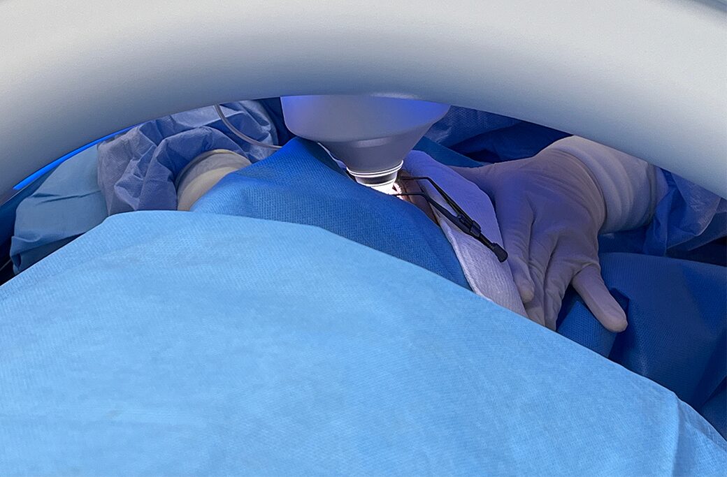 How Femtosecond Laser Cataract Surgery Is Performed