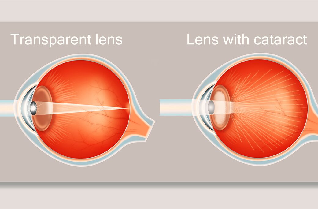 Understanding Laser-Assisted Cataract Surgery