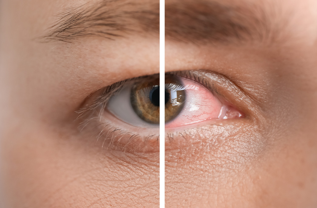 What Is Dry Eye and Why It Shouldn’t Be Ignored