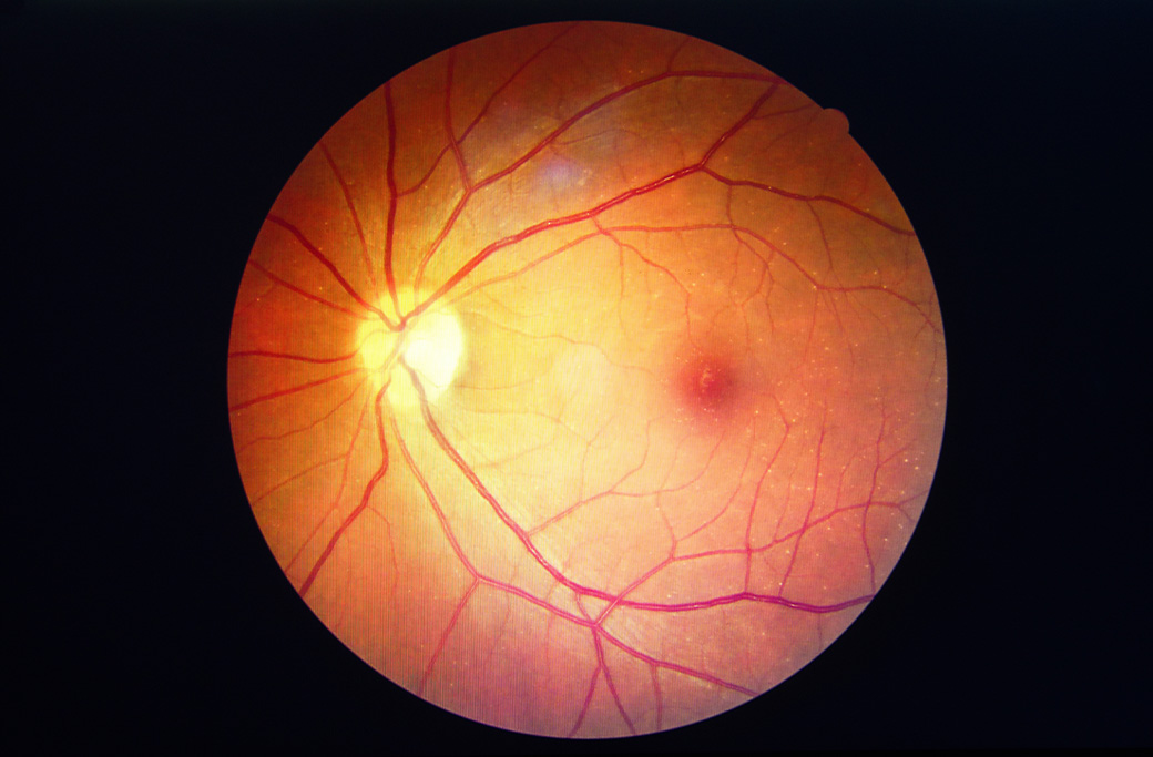 How Retina Conditions Are Diagnosed