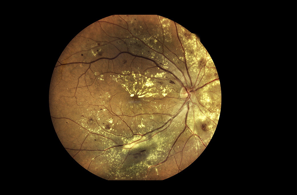 Retina Conditions We Treat