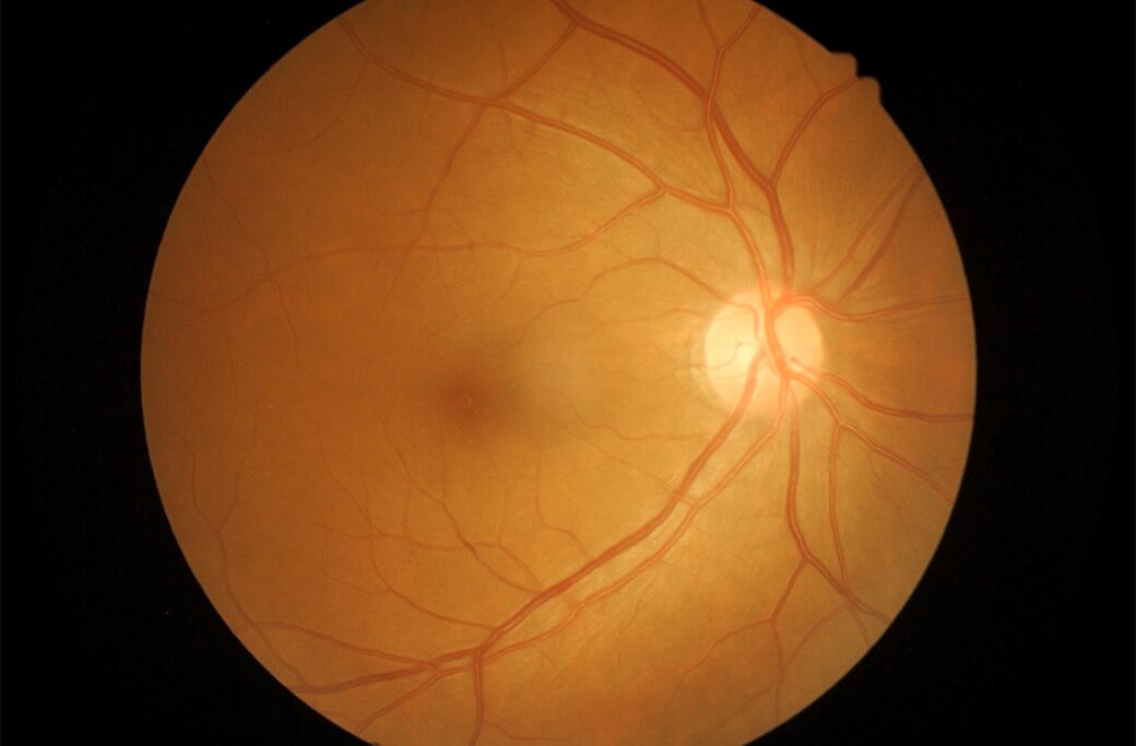 Retinal Conditions: Silent but Serious