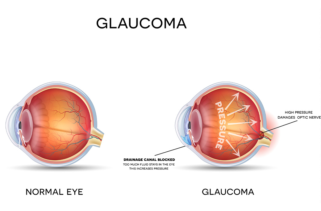 What Is Glaucoma & Why Treatment Matters