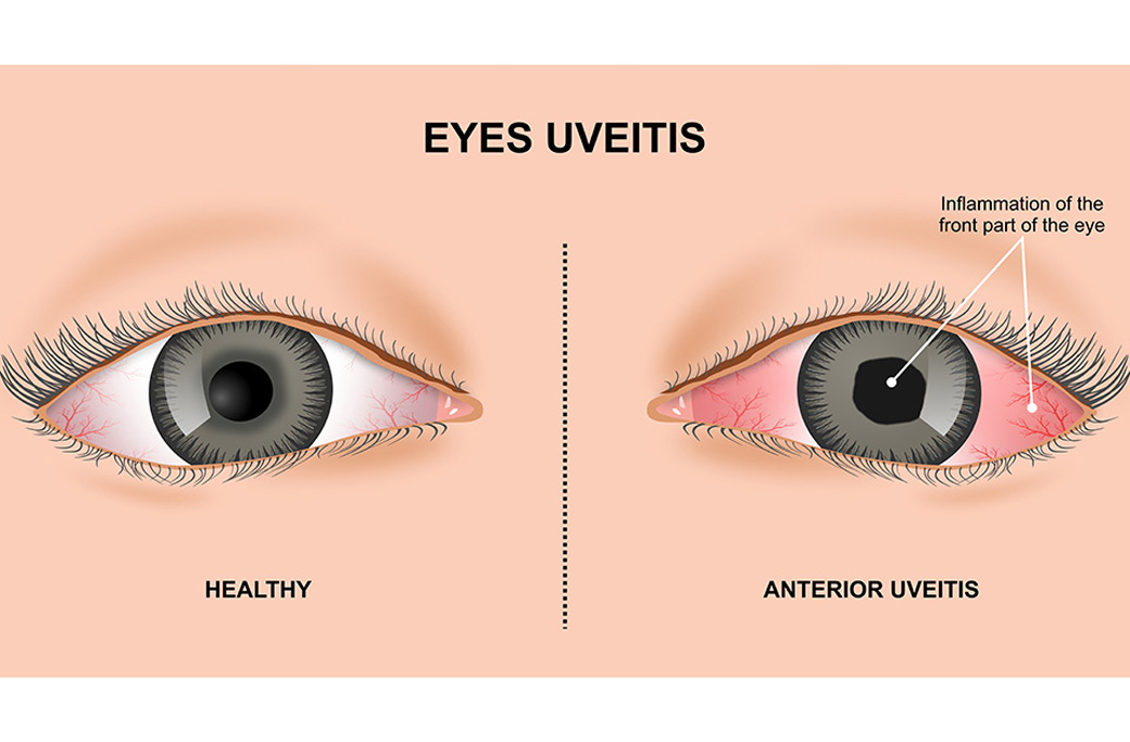 What Is Uveitis?