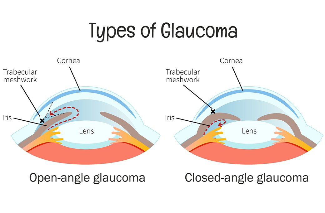 Who Is a Candidate for Glaucoma Laser Treatment?