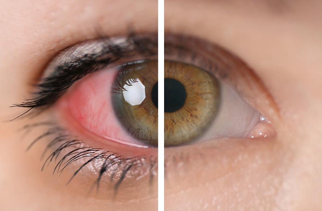 Why Uveitis Can Become Serious