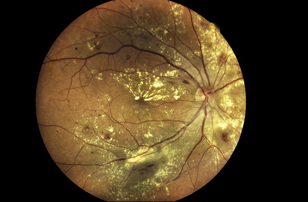 Treatment Options for Macular Degeneration