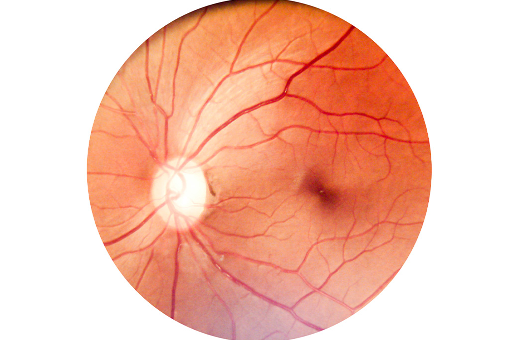 What Is Diabetic Retinopathy?