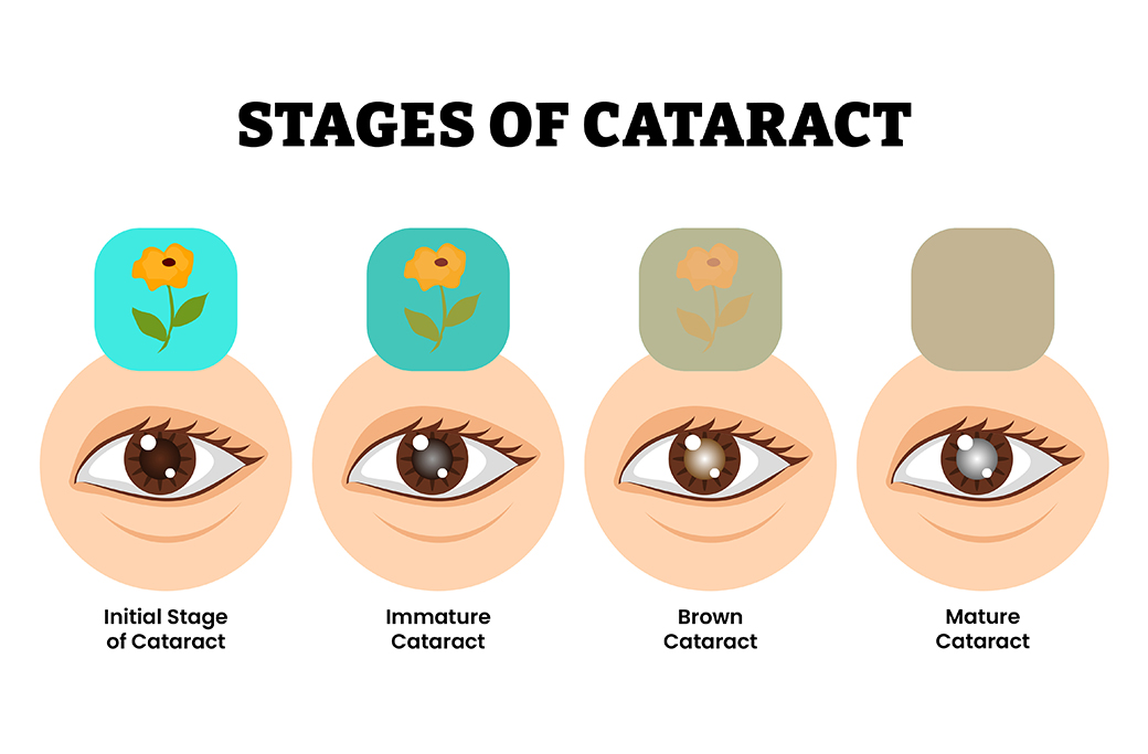 Can Cataract Surgery Be Delayed?