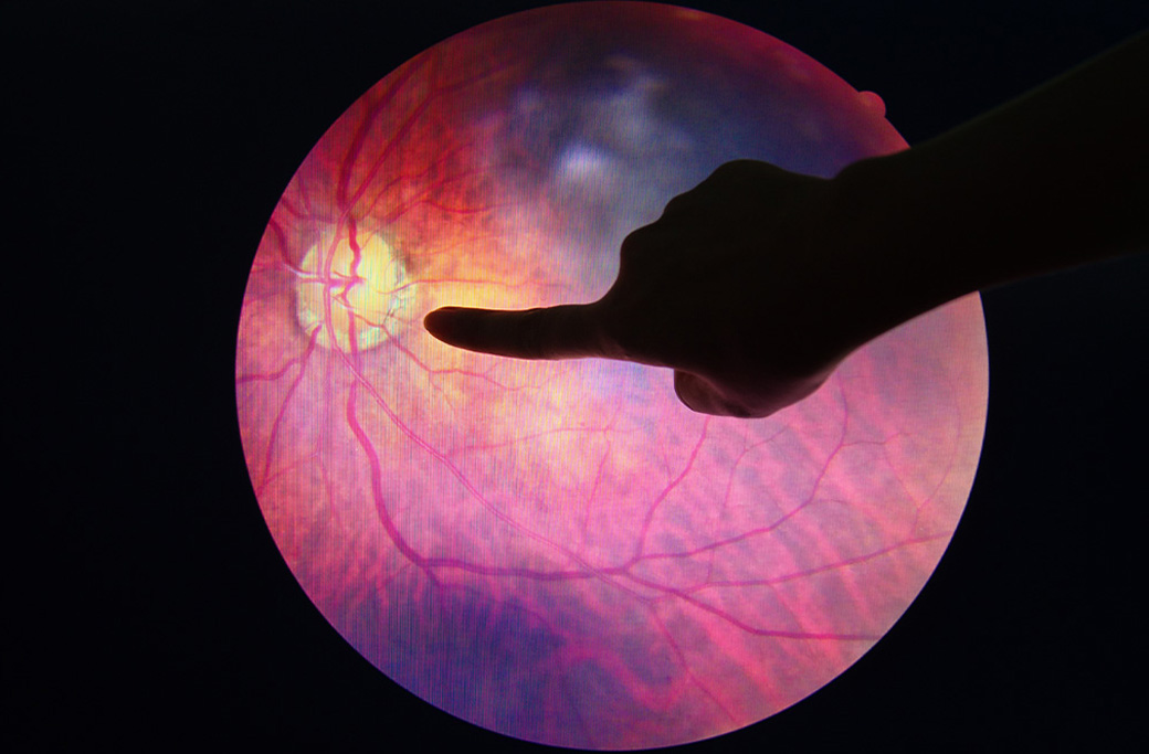 Is Diabetic Retinopathy Reversible in Early Stages?