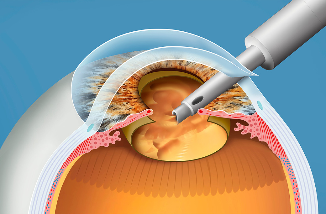What Advanced Cataract Surgery Options Does MERSI Offer?