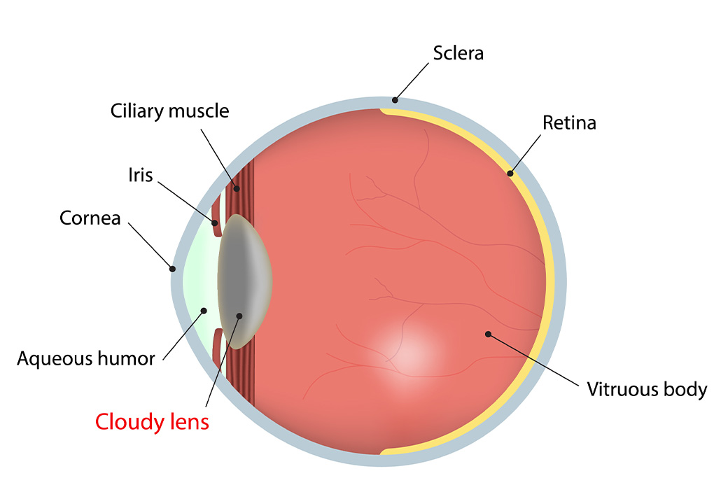 What Are Cataracts?