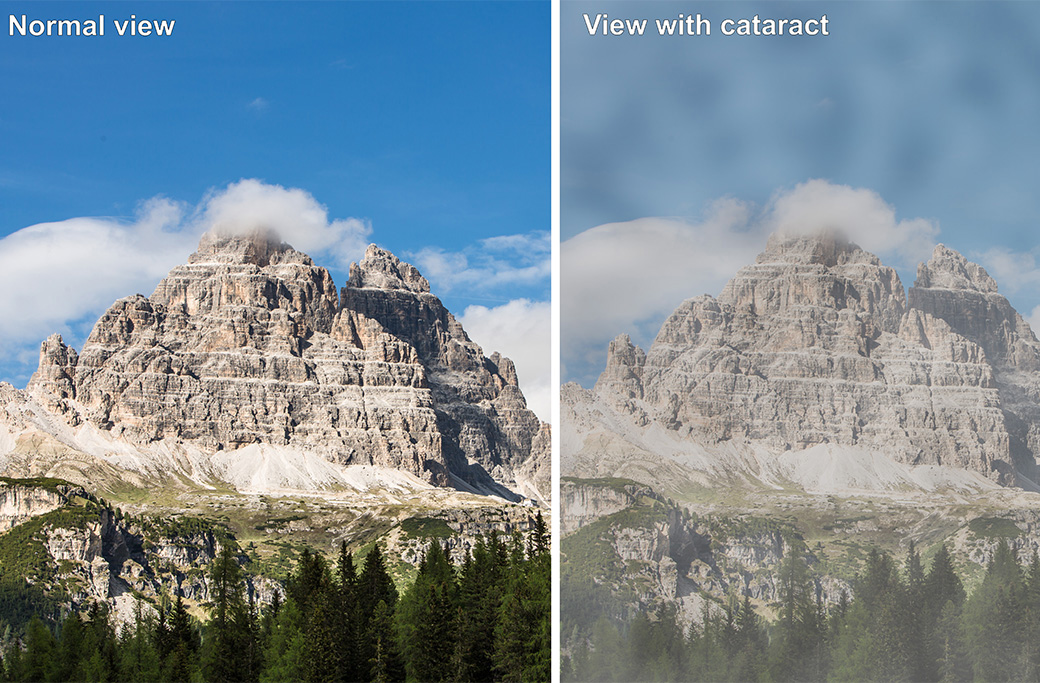 What Are the Most Common Symptoms of Cataracts?