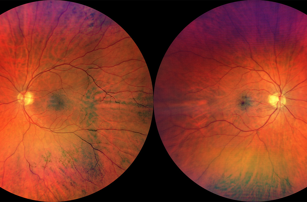 Fundus photograph showing retinal structures monitored during chronic uveitis care.