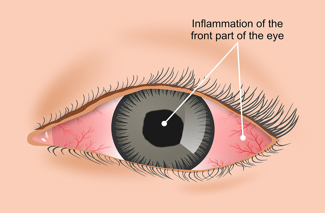 How Does A Slit-Lamp Examination Detect Anterior Uveitis?