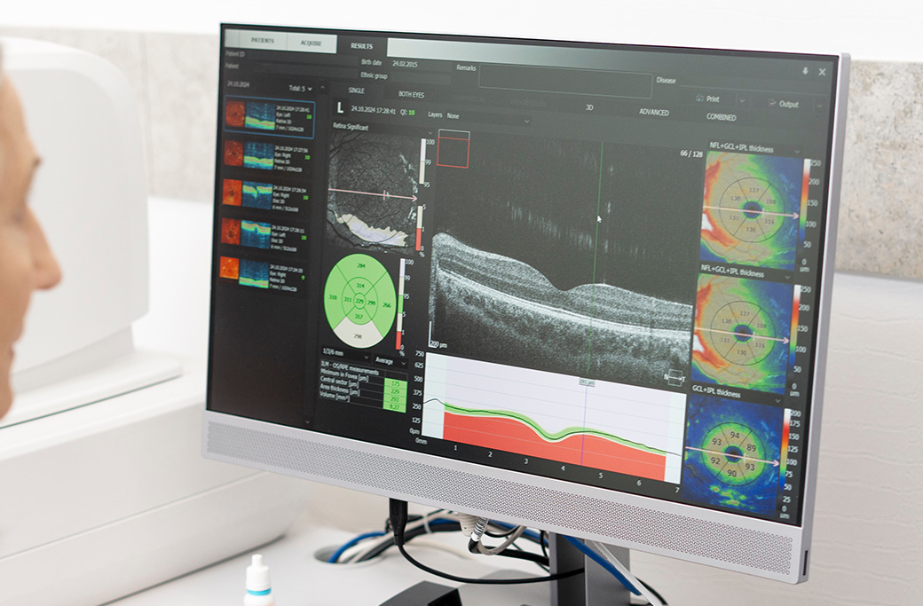 OCT retinal imaging used to monitor inflammation and macular edema in chronic uveitis.