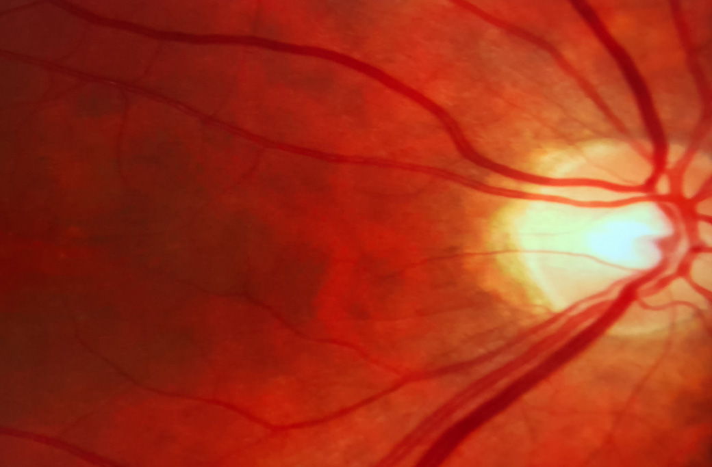 Wide-field retinal image used to evaluate sudden flashes and floaters