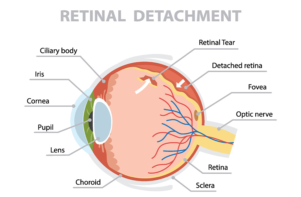 Medical illustration showing retinal detachment inside the eye