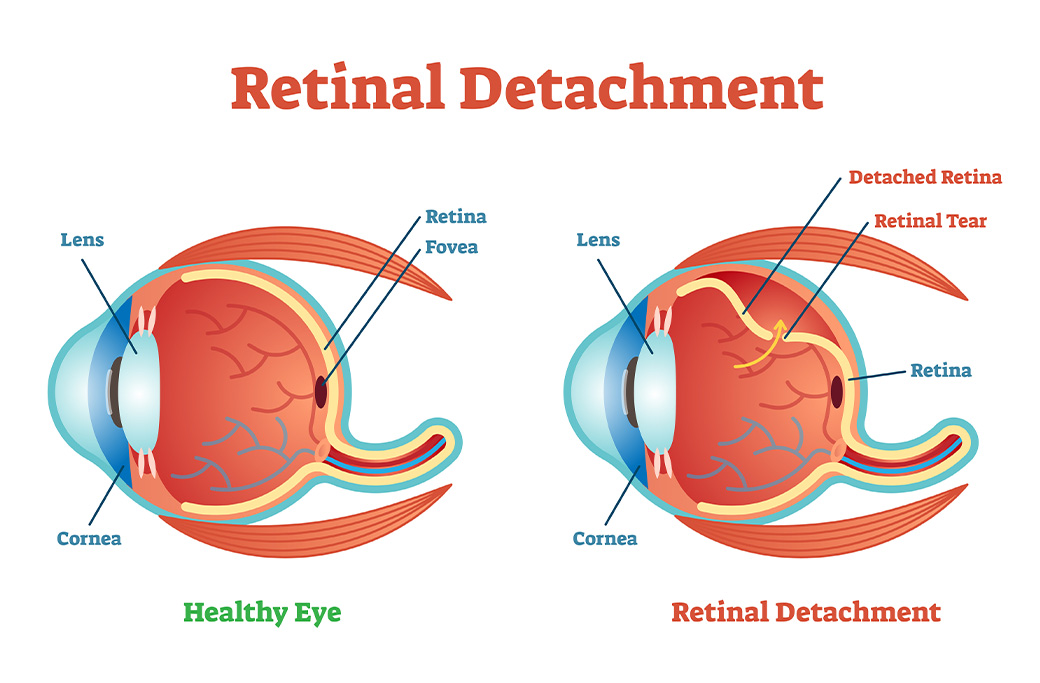 Medical illustration showing a retinal detachment inside the eye