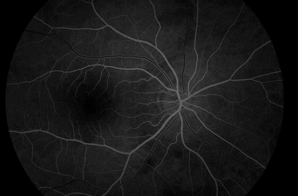 Fluorescein Angiogram (FA) may also be used.