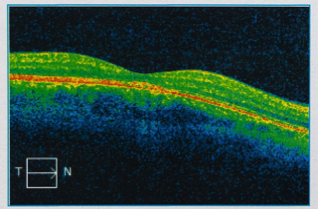 OCT scan showing fluid and swelling within the macula