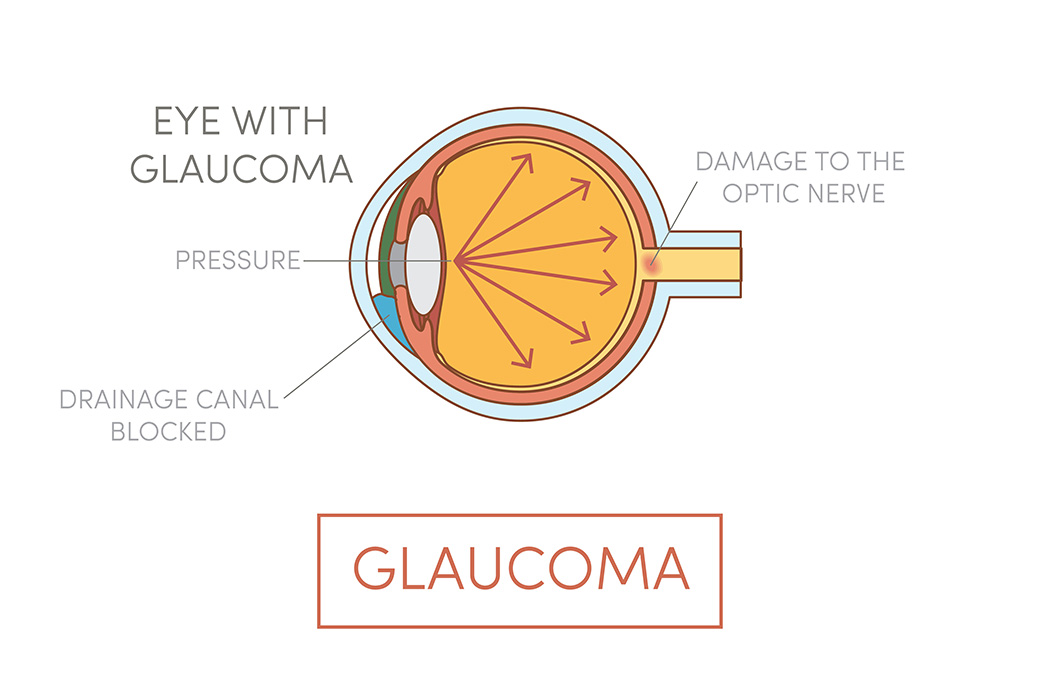Diagram of the eye showing the optic nerve and drainage angle affected by glaucoma.