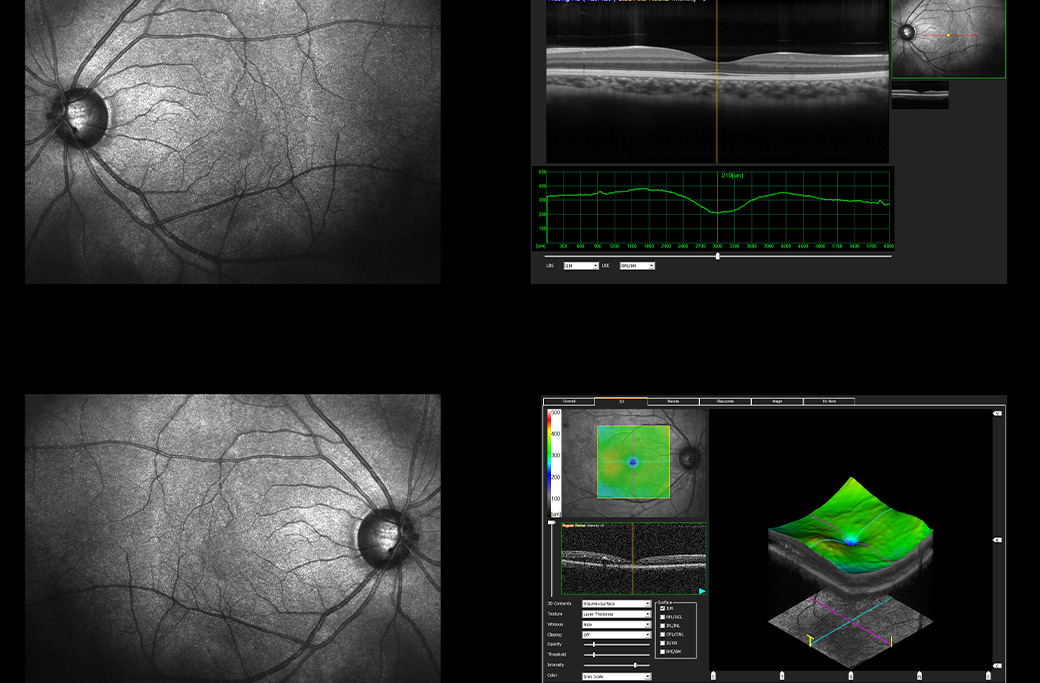 Retinal photograph and OCT cross-section showing two views of the retina.