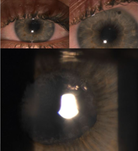 young woman 20s acute glaucoma