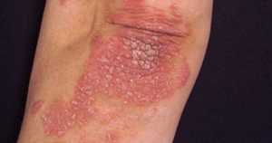 figure 1 typical appearance of psoriasis on the elbow