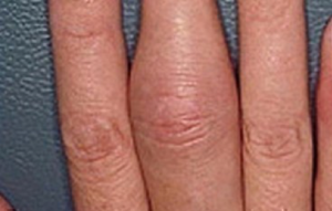 figure 2 psoriatic arthritis swollen fingers