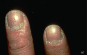figure 3 nail psoriasis with nail pitting