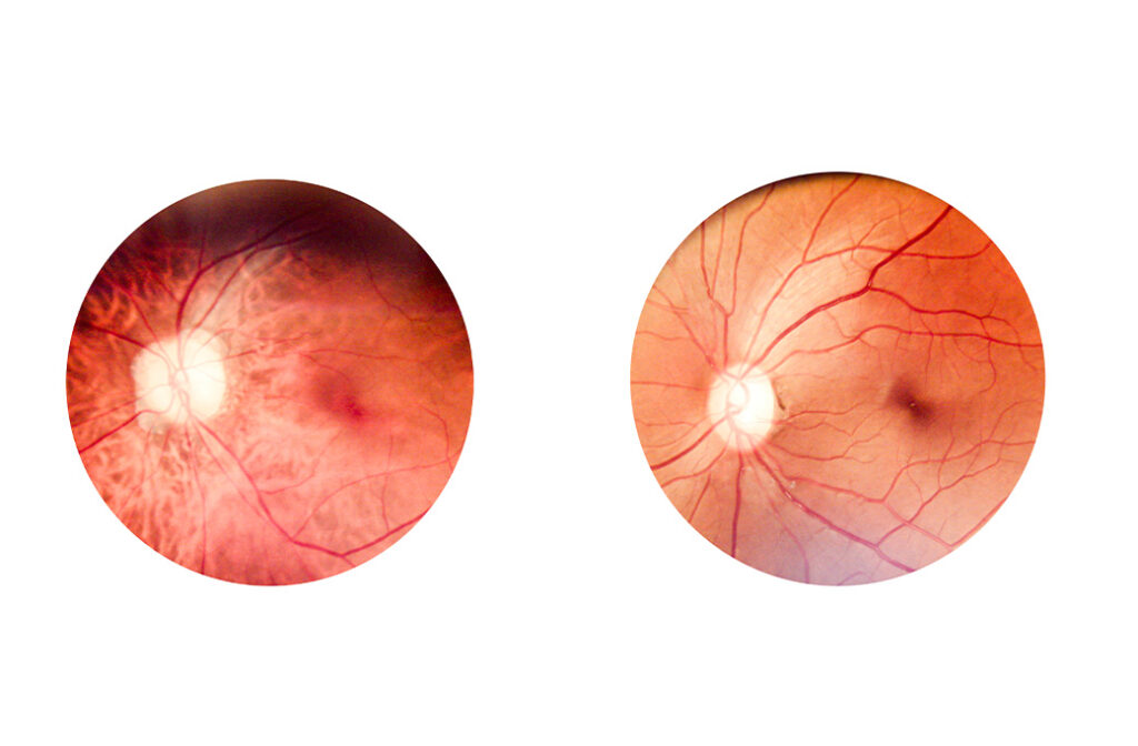Can Diabetes Damage Your Retina? | MERSI Retina Care
