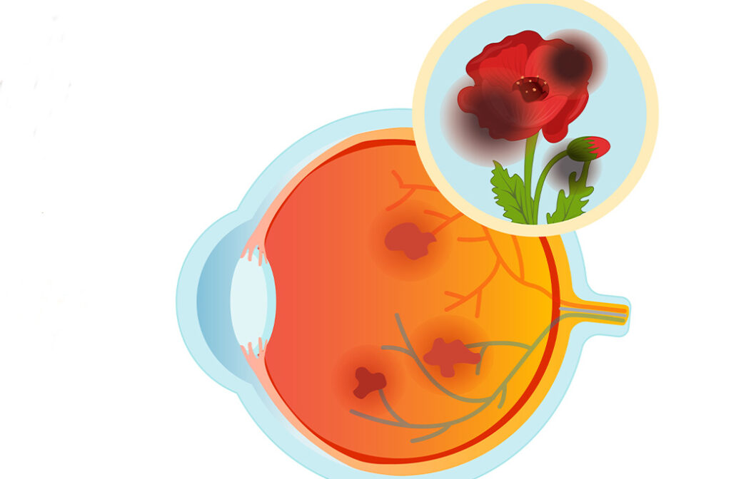 Symptoms of Diabetic Retinopathy | Warning Signs to Watch