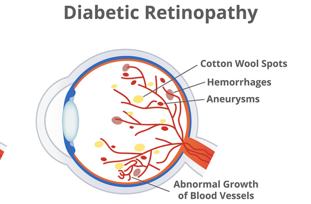 Can Diabetic Retinopathy Be Reversed?