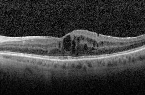 Optical coherence tomography (OCT) scan of a patient with diabetic macular edema showing retinal thickening and fluid-filled spaces in the macula.