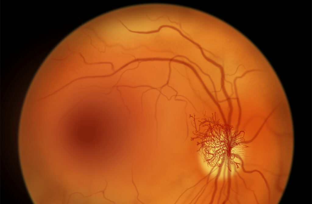 What Is Diabetic Macular Edema (DME)? | MERSI